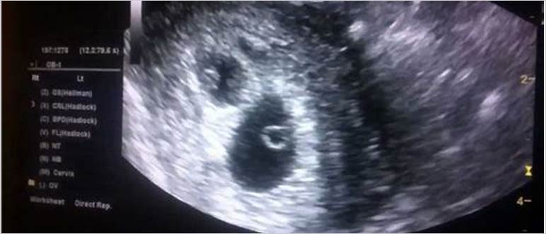 6 weeks ultrasound twins